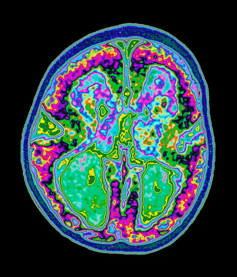 Colored brain scan
